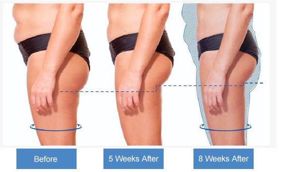 DOES HIEMT BODY SCULPTING TECHNOLOGY WORK? - Body Contouring