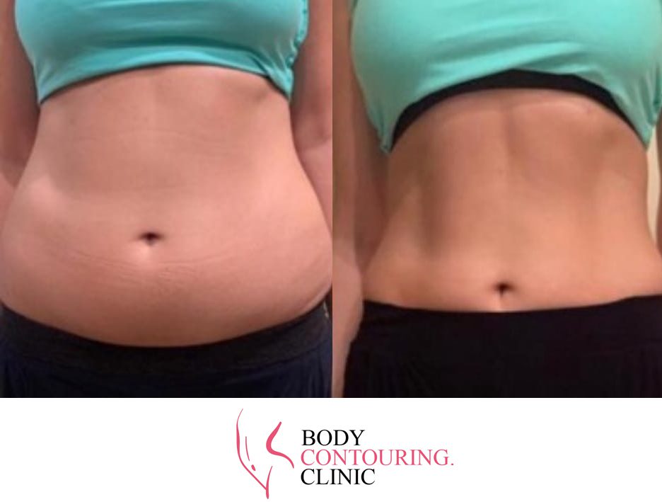 DOES HIEMT BODY SCULPTING TECHNOLOGY WORK? - Body Contouring